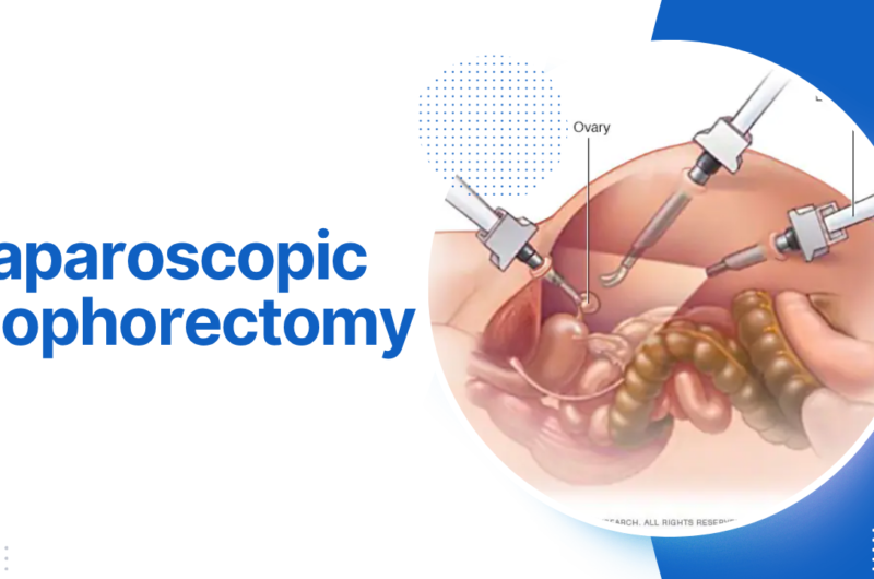 Laparoscopic Oophorectomy