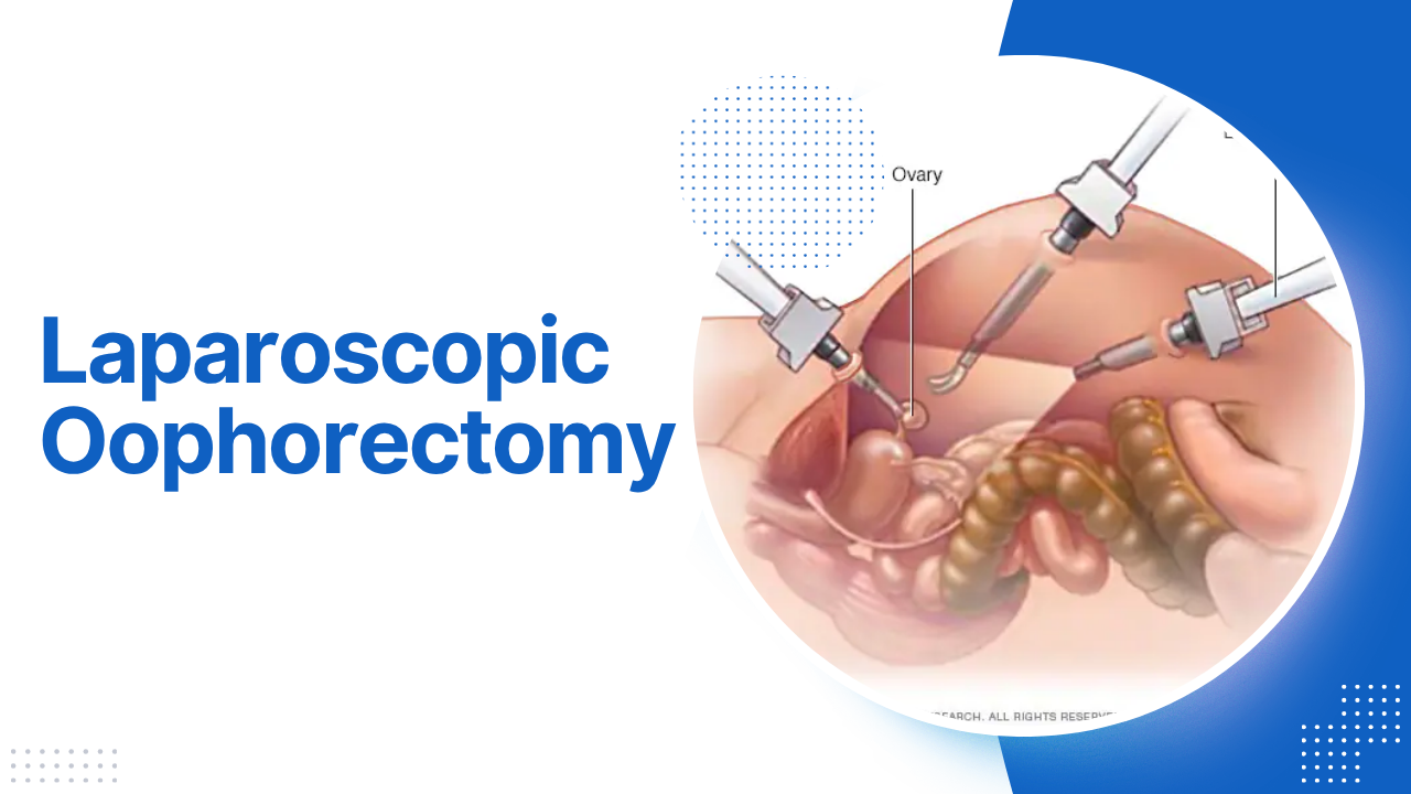 Laparoscopic Oophorectomy