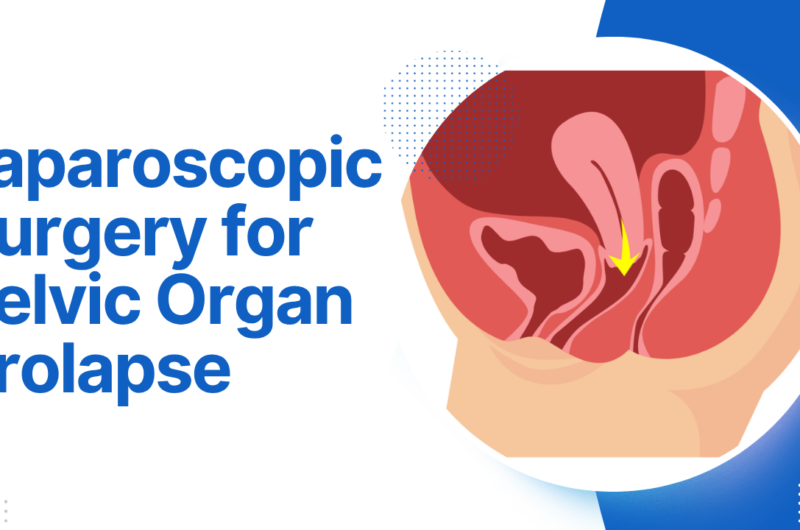 Laparoscopic Surgery for Pelvic Organ Prolapse