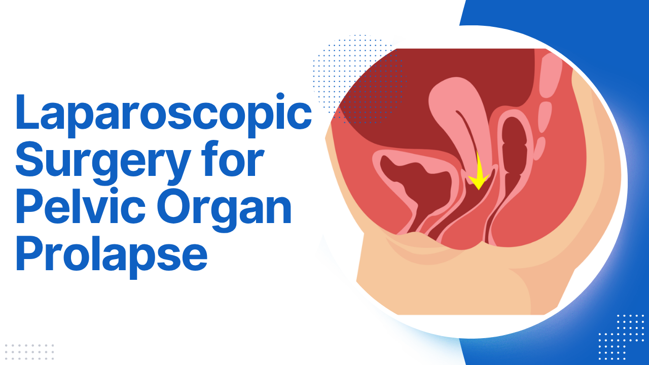 Laparoscopic Surgery for Pelvic Organ Prolapse