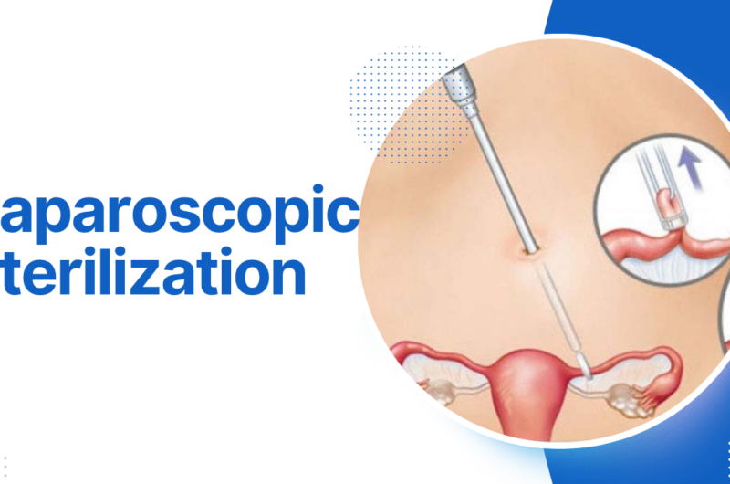 Laparoscopic sterilization