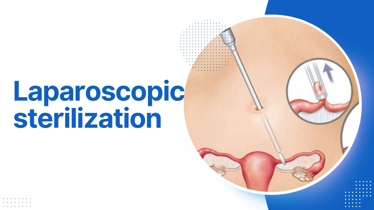 Laparoscopic sterilization
