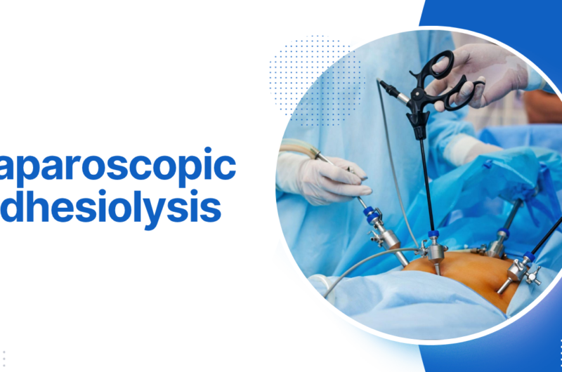 Laparoscopic Adhesiolysis