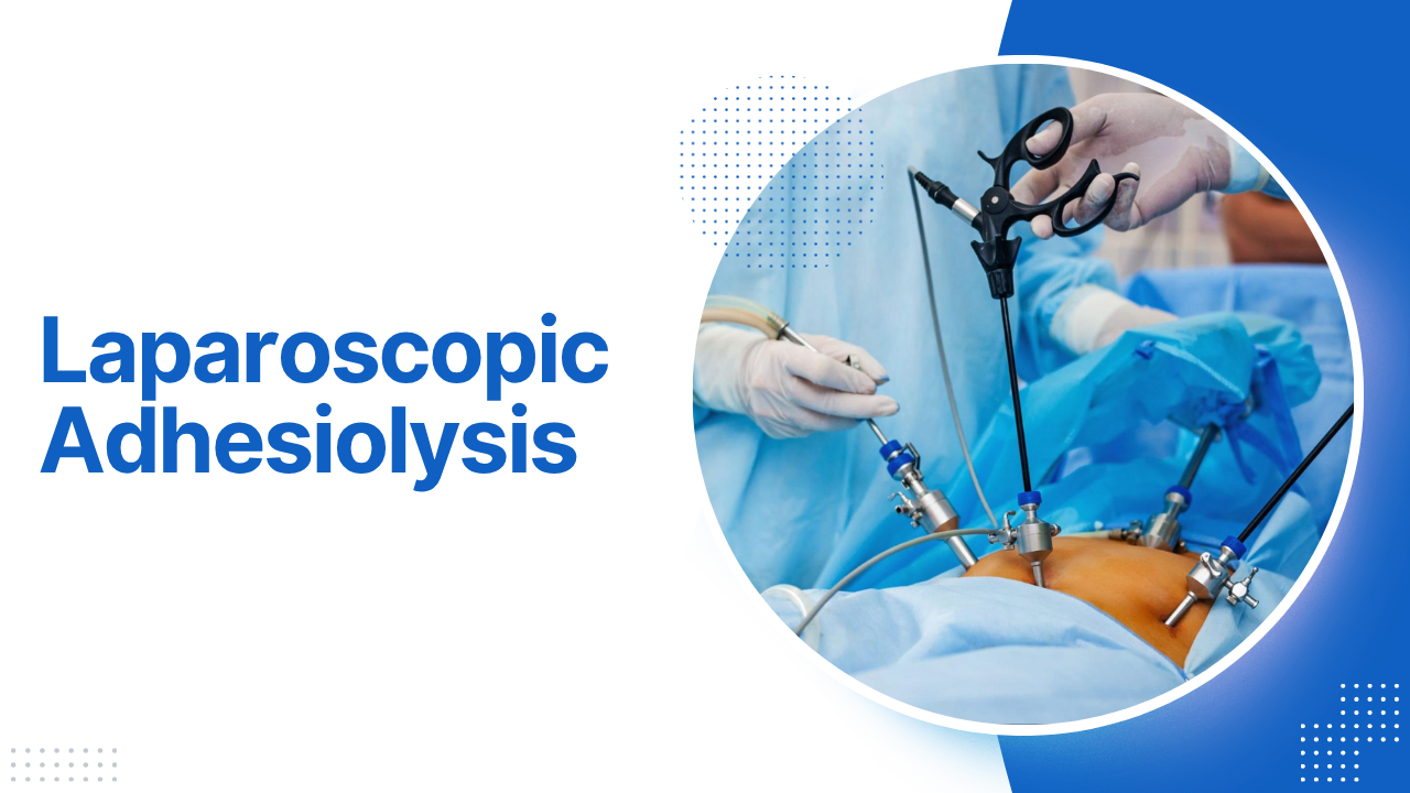 Laparoscopic Adhesiolysis