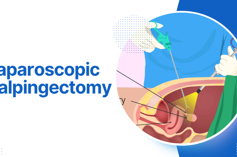 Laparoscopic Salpingectomy