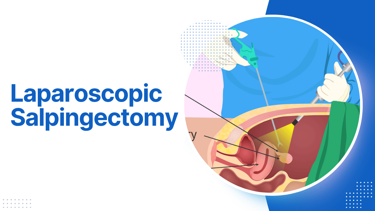 Laparoscopic Salpingectomy