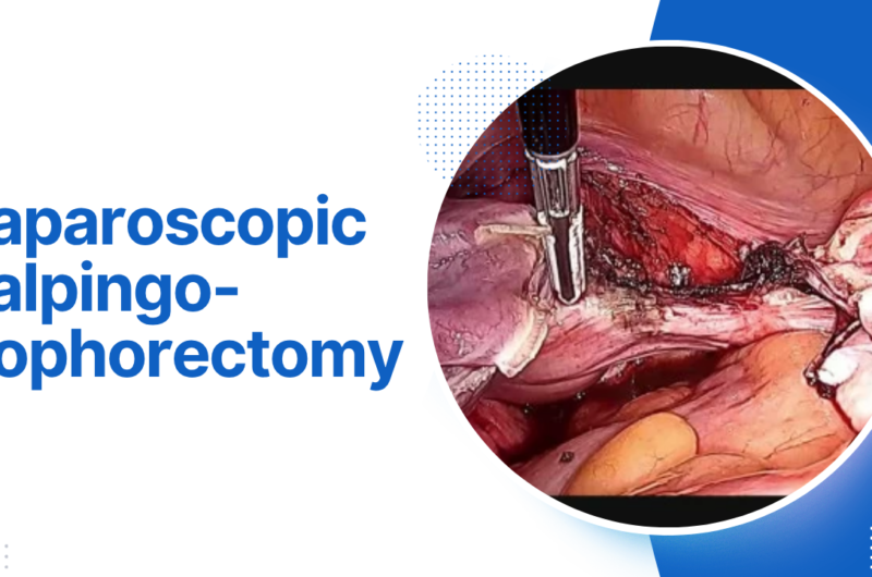 Laparoscopic salpingo-oophorectomy