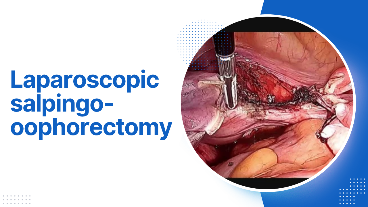 Laparoscopic salpingo-oophorectomy