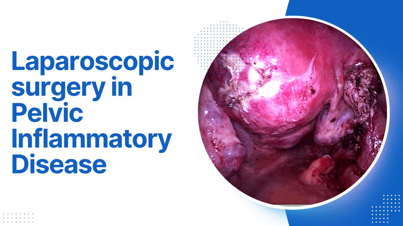 Laparoscopic surgery in Pelvic Inflammatory Disease (PID)