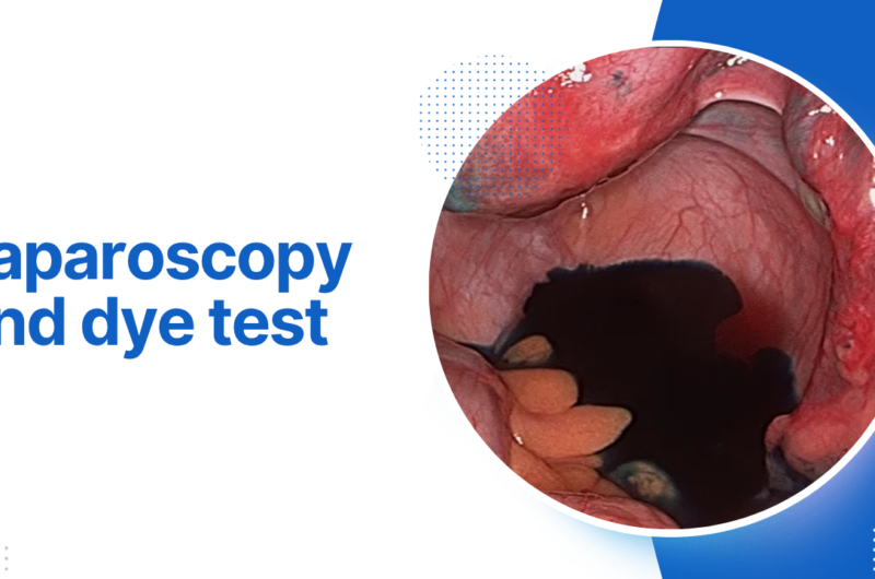 Laparoscopy and dye test