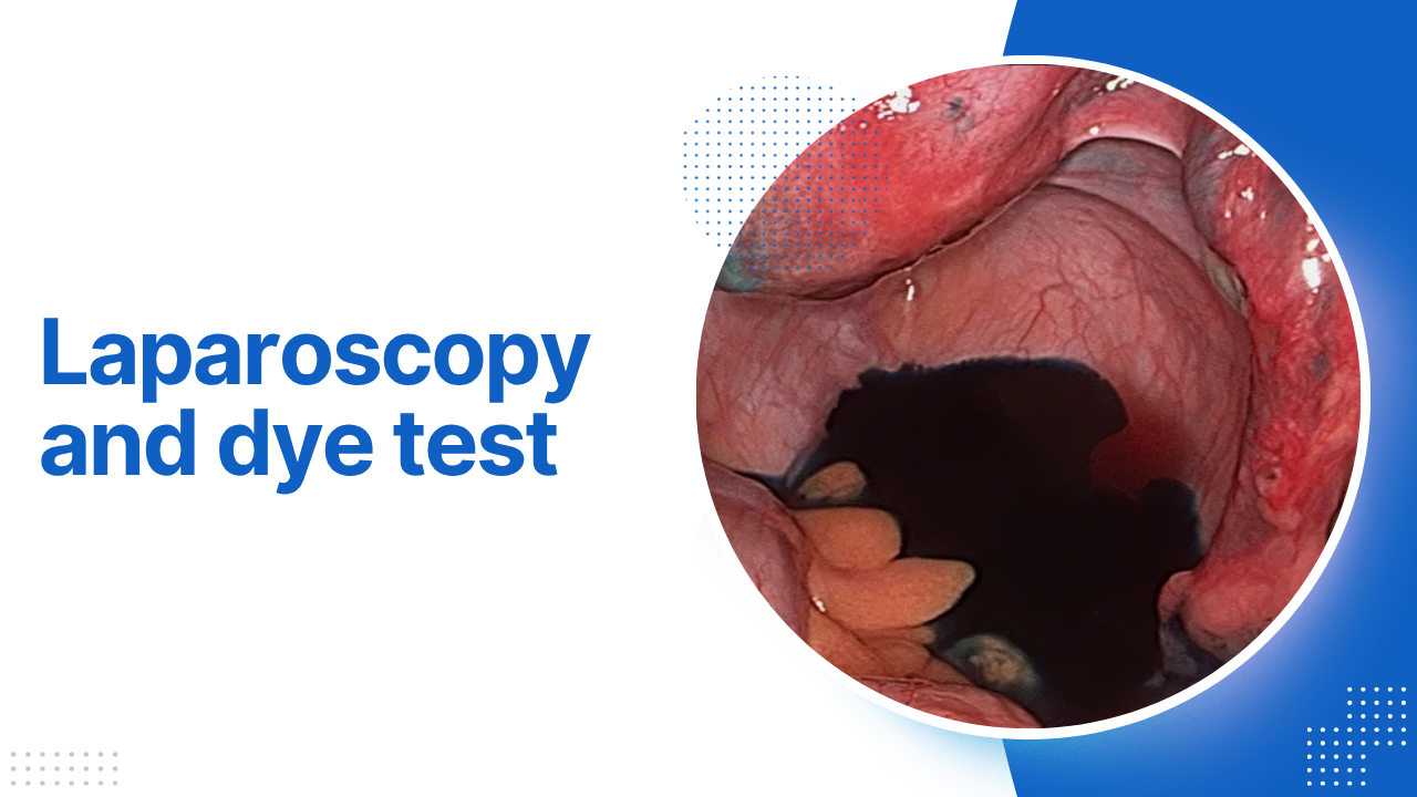 Laparoscopy and dye test