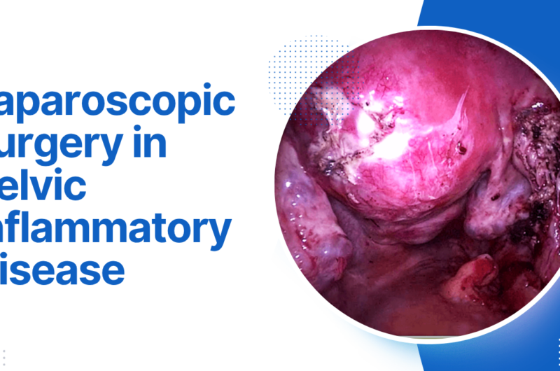 Pelvic Pain, Fertility Concerns, and Diagnostic Laparoscopy: What to Discuss